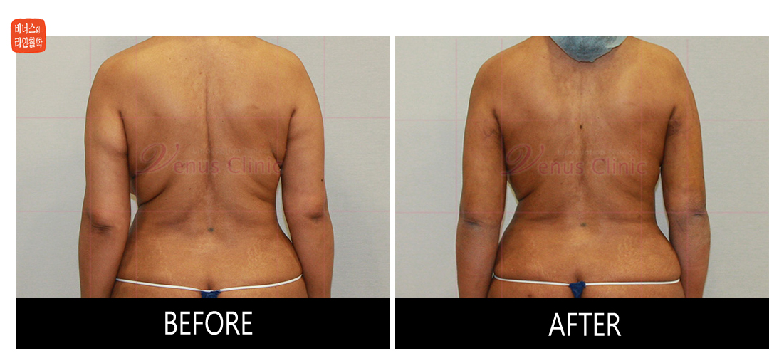 reoperation liposuction of arms4.jpg
