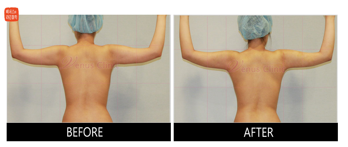 reoperation liposuction of arms5.jpg
