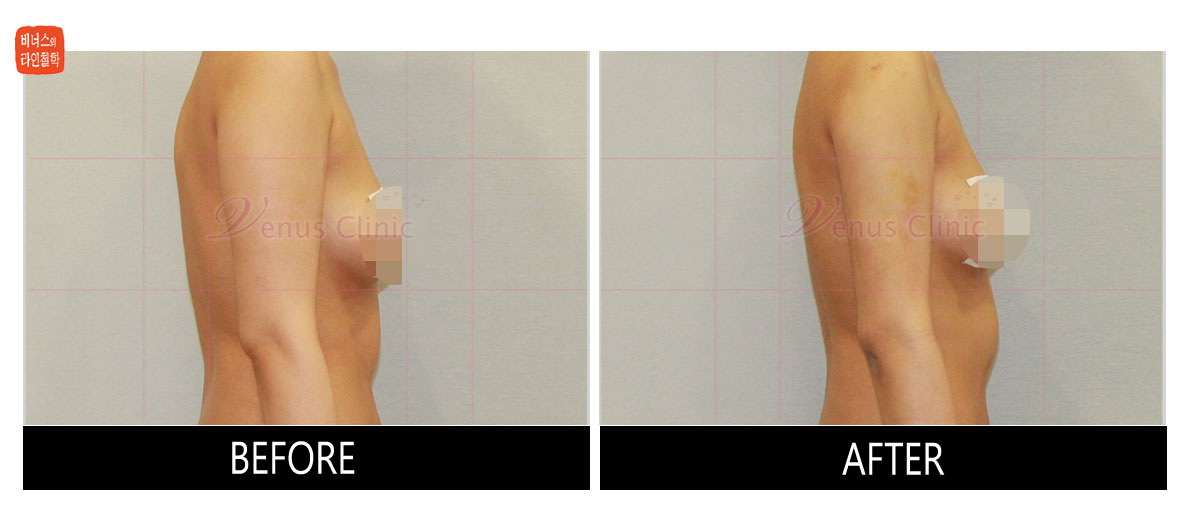 reoperation liposuction of arms7.jpg