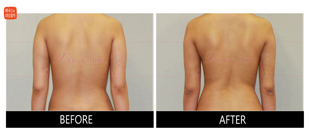 reoperation liposuction of arms4.jpg