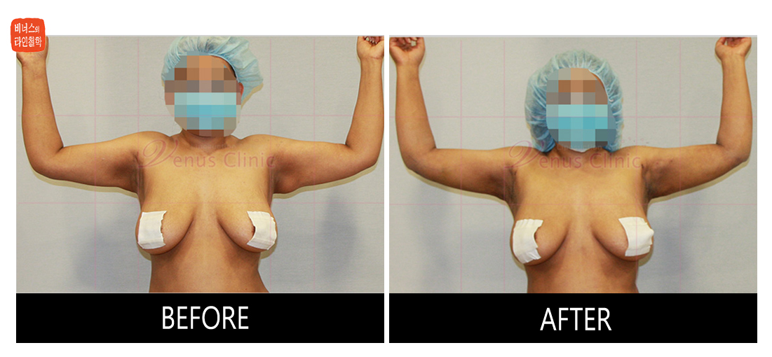 reoperation liposuction of arms.jpg