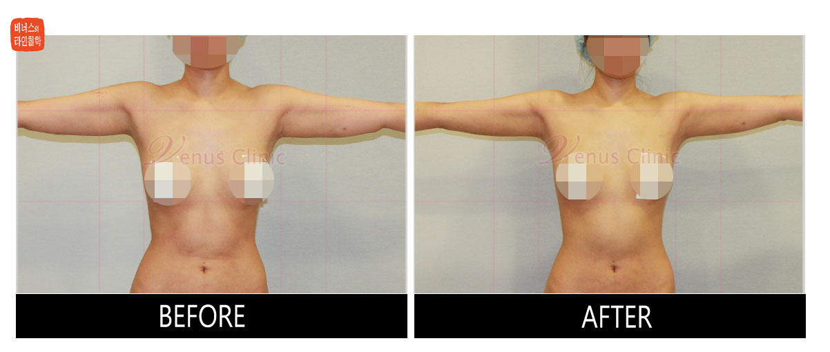 reoperation liposuction of arms2.jpg
