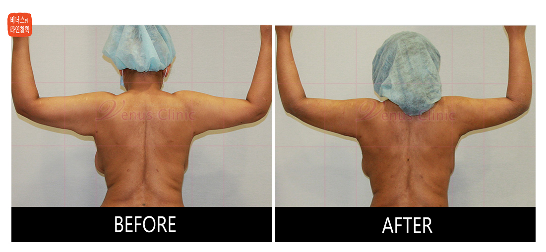reoperation liposuction of arms3.jpg