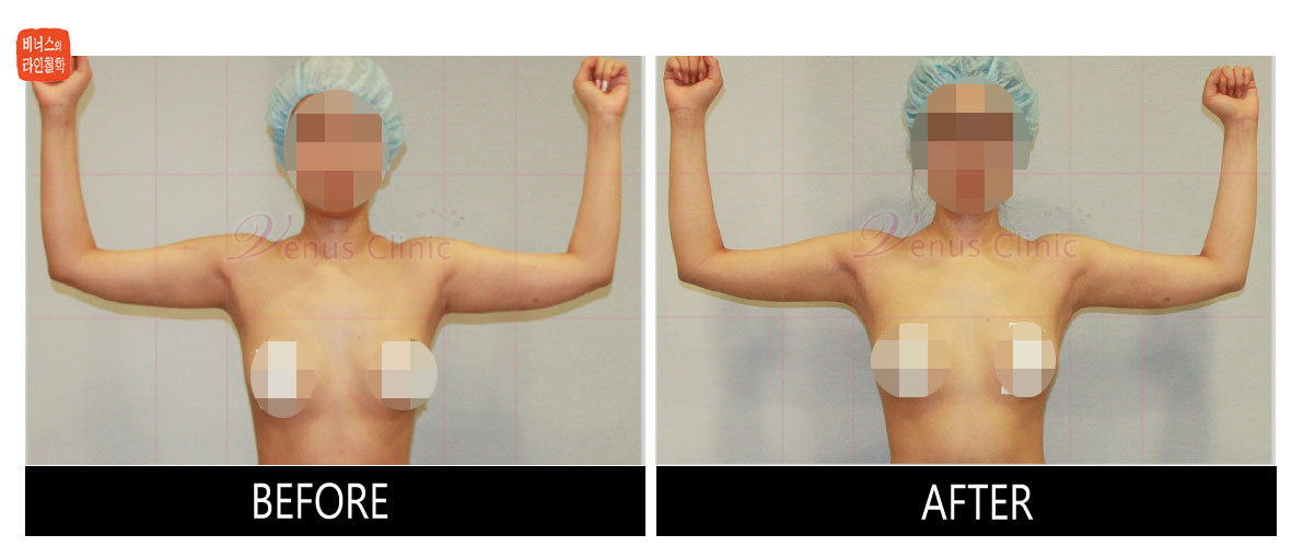 reoperation liposuction of arms1.jpg