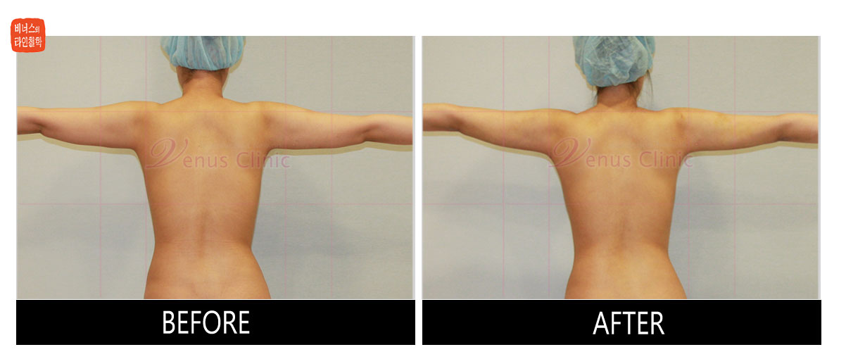 reoperation liposuction of arms6.jpg