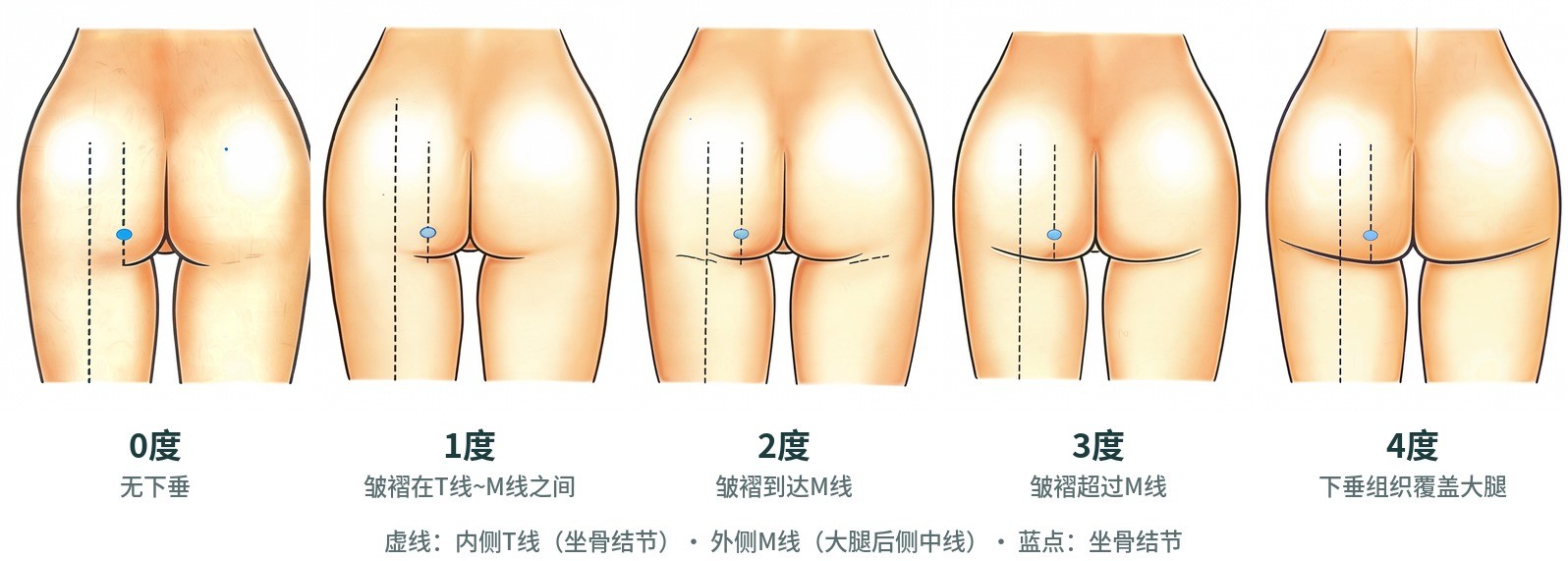 臀部下垂0度~4度背面 — T线与M线
