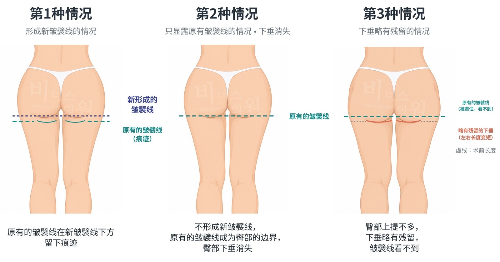 臀部丰臀提升吸脂后皱襞线的三种情况 — 第1种形成新皱襞线，第2种只显露原有皱襞线，第3种下垂略有残留