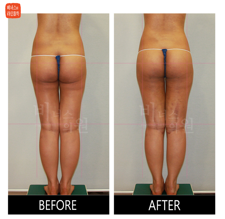 reoperation liposuction of thighs and buttocks_5.jpg