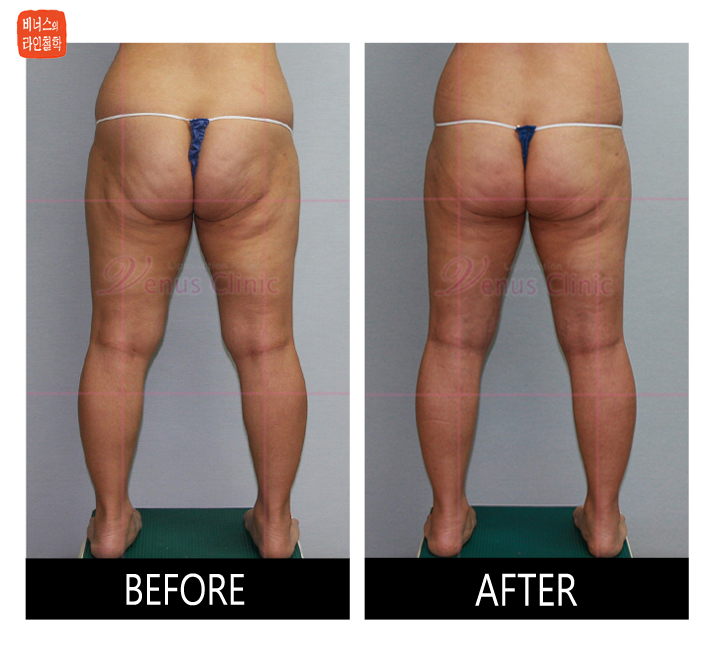 reoperation liposuction of thighs and buttocks_2.jpg