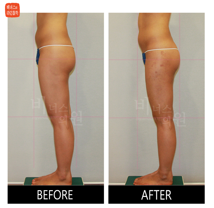 reoperation liposuction of thighs and buttocks_4.jpg