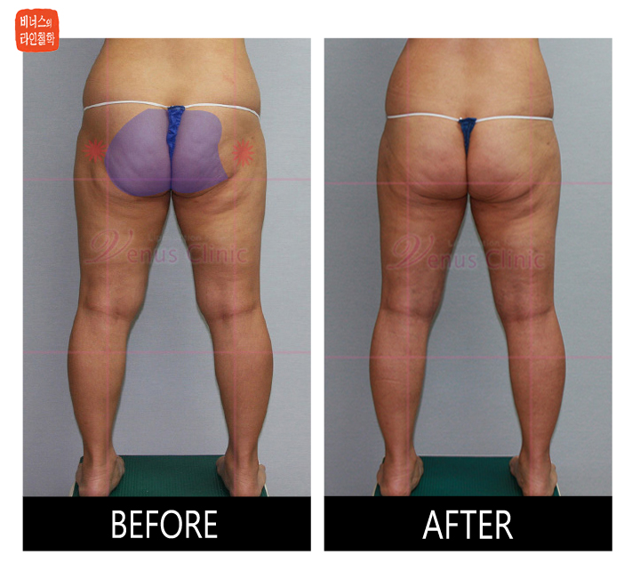 reoperation liposuction of thighs and buttocks_1.jpg