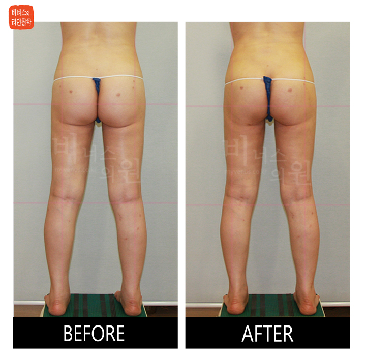 reoperation liposuction of thighs and buttocks_9.jpg