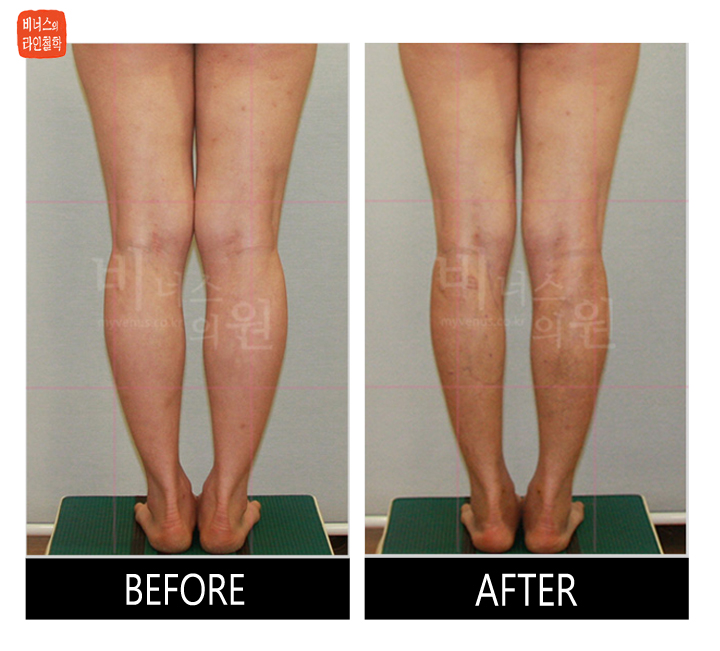before and after of calf liposuction11