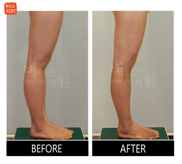 before and after of calf liposuction13