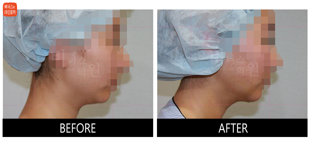 liposuction photos of face and neck13