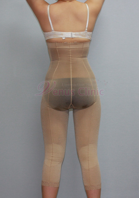 liposuction garment