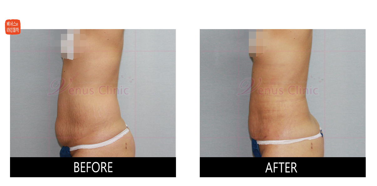 skin irregualarity after liposuction