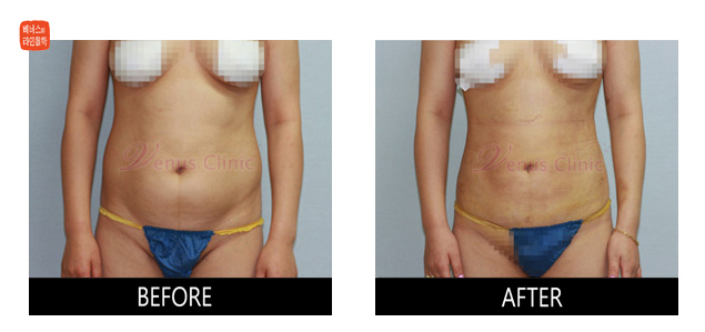 before and after abdominal liposuction1