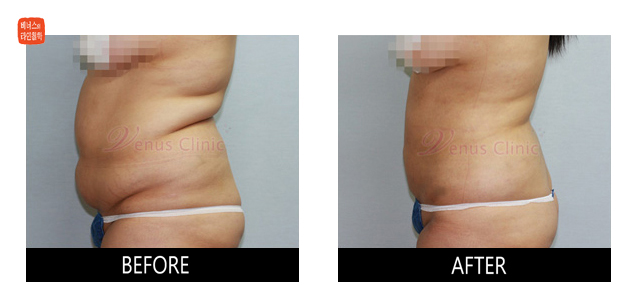 before and after upper and lower abdomen liposuction