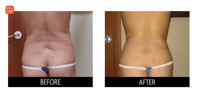 before and after liposuction of flanks