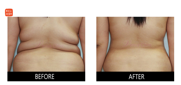 before and after liposuction of upper back(femanle flanks)