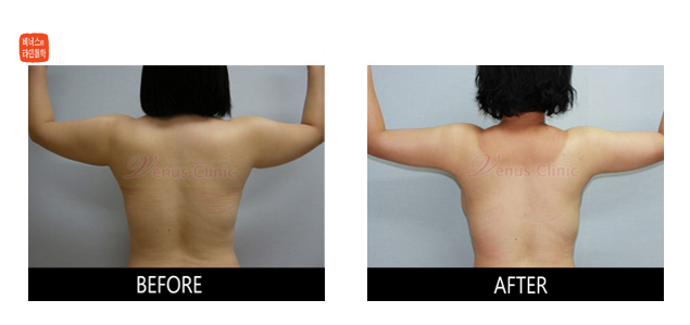 before and after liposuction of axilla