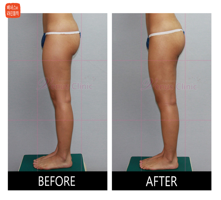 lateral view of thighs before and after liposuction