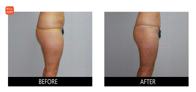 anterior thighs liposuction