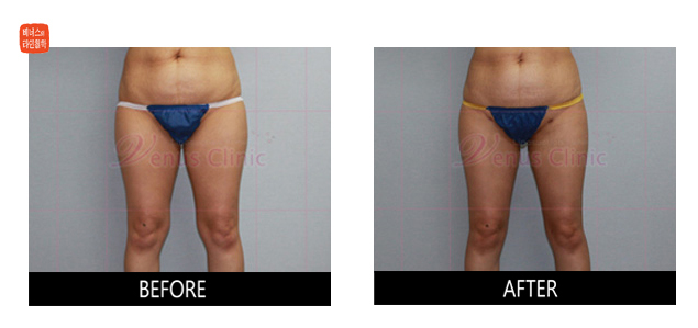 medial thighs liposuction