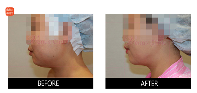 liposuction of face and neck