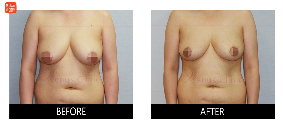 liposuction for breasts reduction