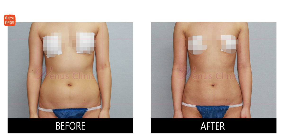 Smooth result of Liposuction