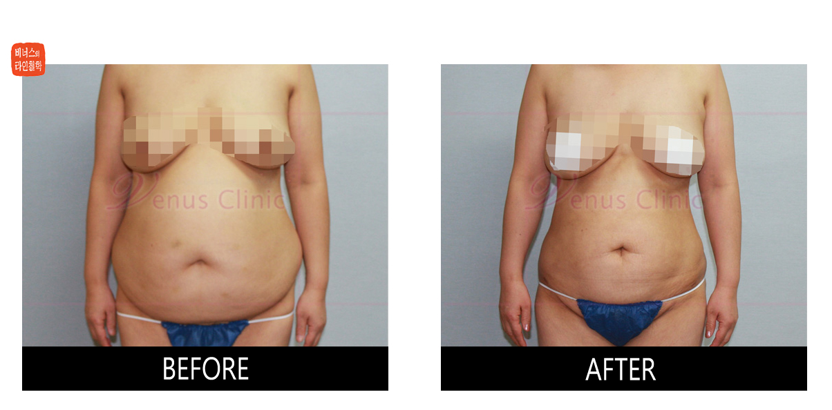 front view of large volume liposuction