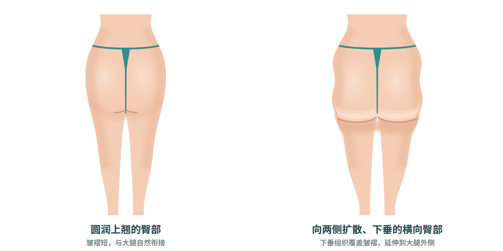 紧致上翘的臀部与向两侧摊开并下垂的臀部背面对比