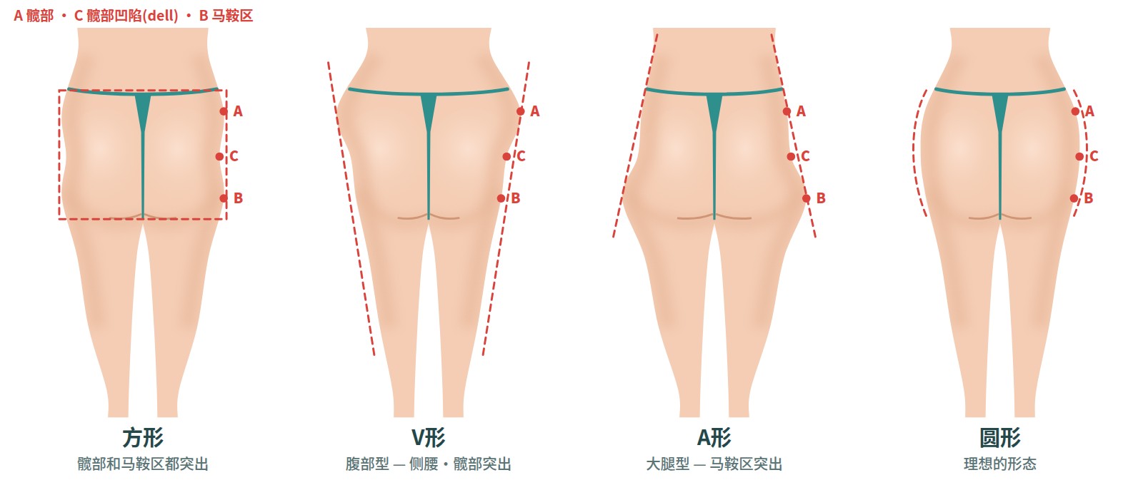 从后面看臀部四种形态的图解 — 方形、V形、A形、圆形以及髋部（A）·dell（C）·马鞍（B）三点