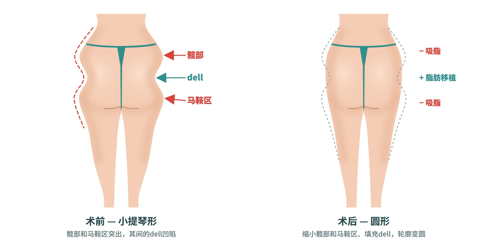 同时进行髋部·臀部·马鞍手术的虚拟术前术后背面图