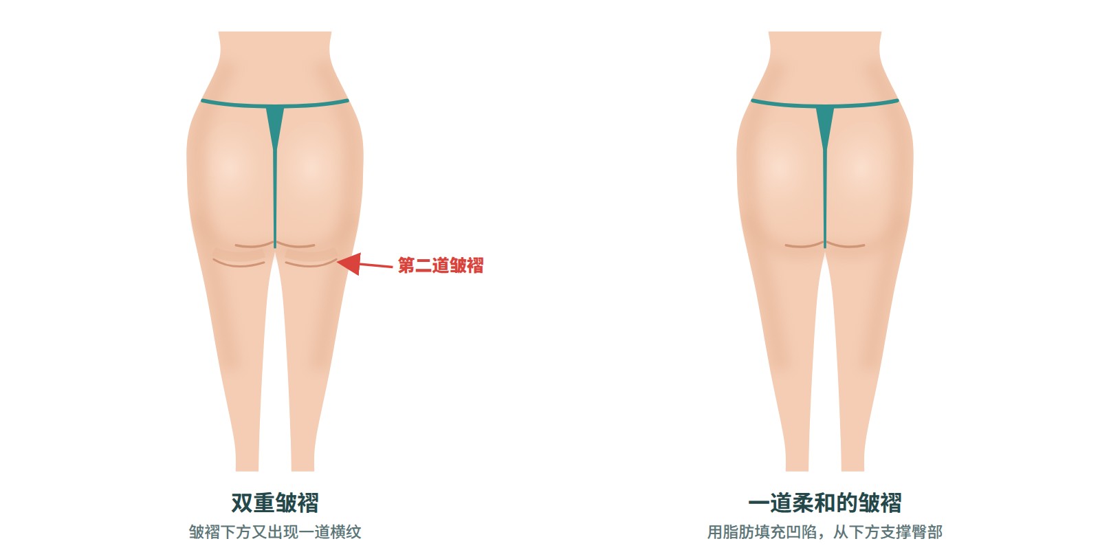 香蕉卷与双重皱褶脂肪移植的虚拟术前术后背面图