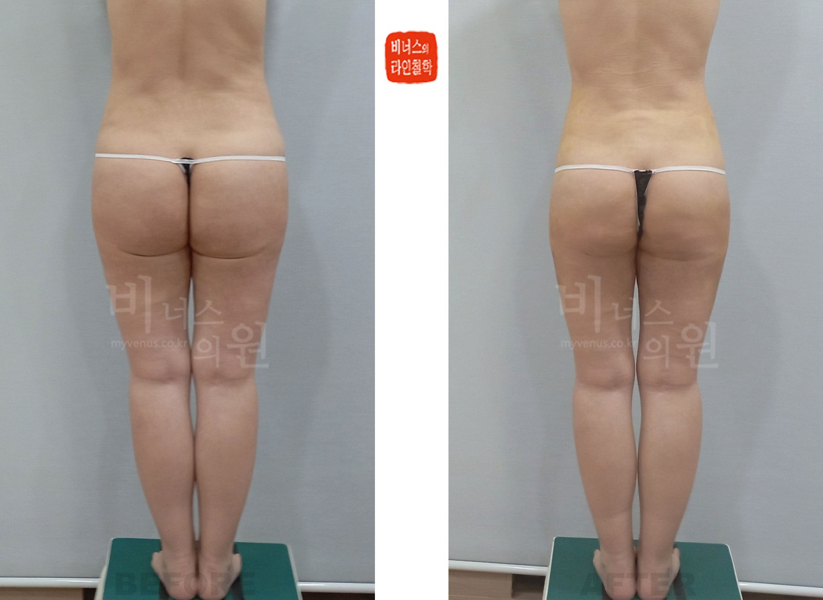 臀部·大腿吸脂修复手术前后对比照片 第二个案例 背面