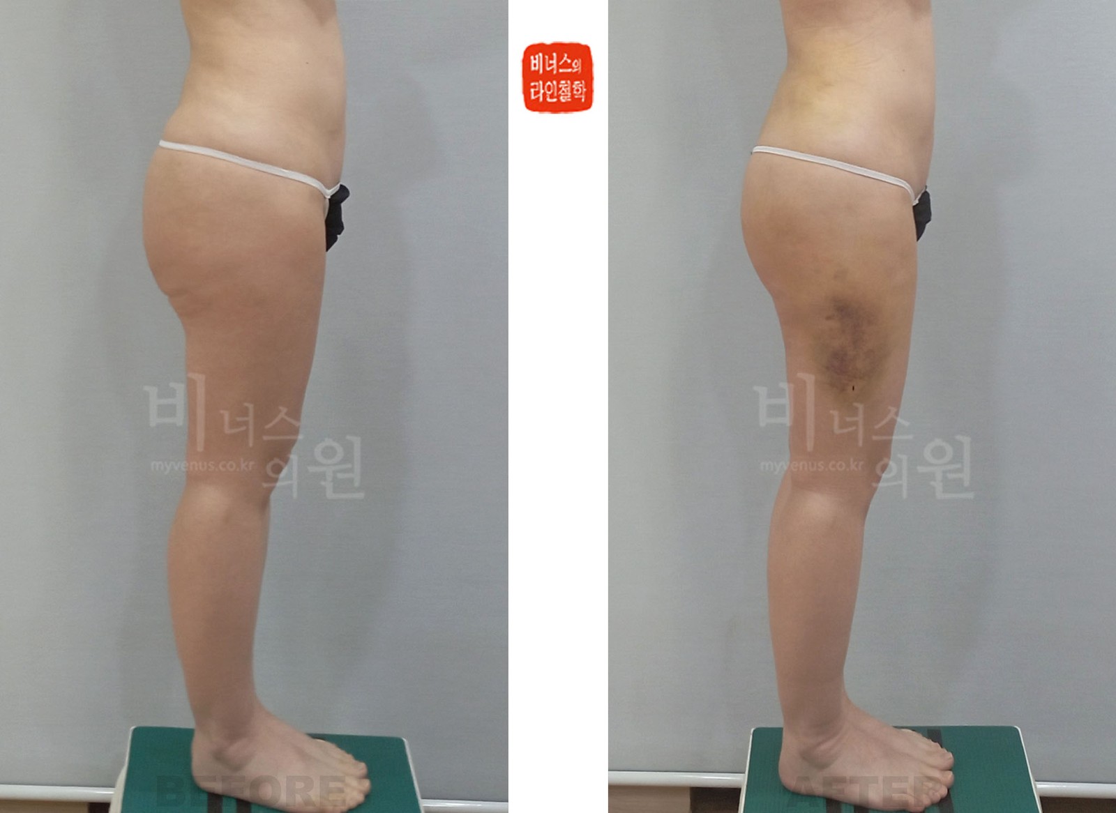 臀部·大腿吸脂修复手术前后对比照片 第二个案例 侧面