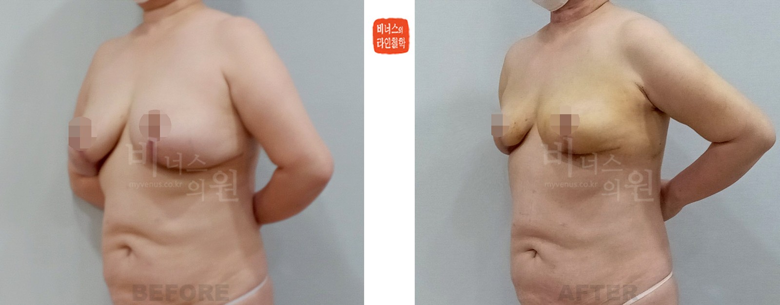切除式乳房缩小术后乳房缩小吸脂术前后对比照 左斜面（术后1周）