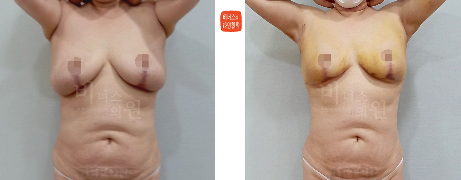 切除式乳房缩小术后乳房缩小吸脂术前后对比照 正面（术后1周）