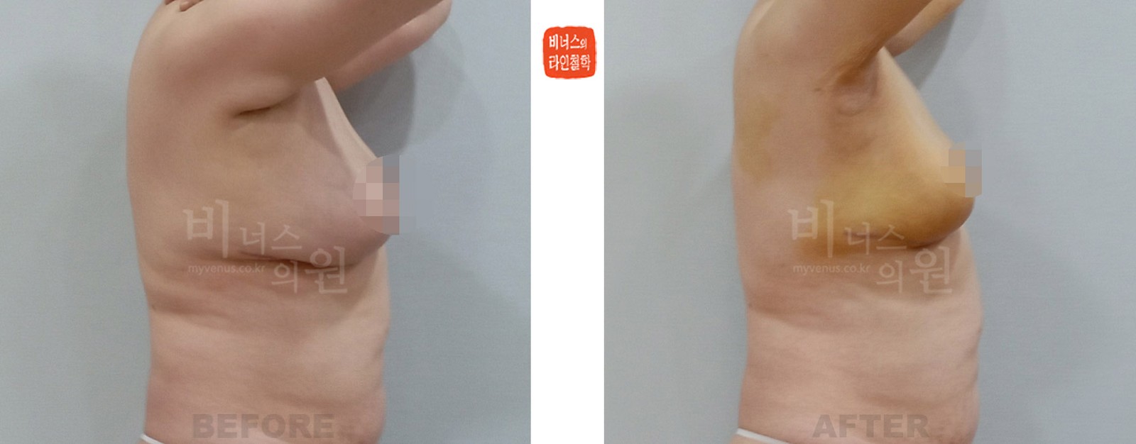 切除式乳房缩小术后乳房缩小吸脂术前后对比照 右侧面（术后1周）