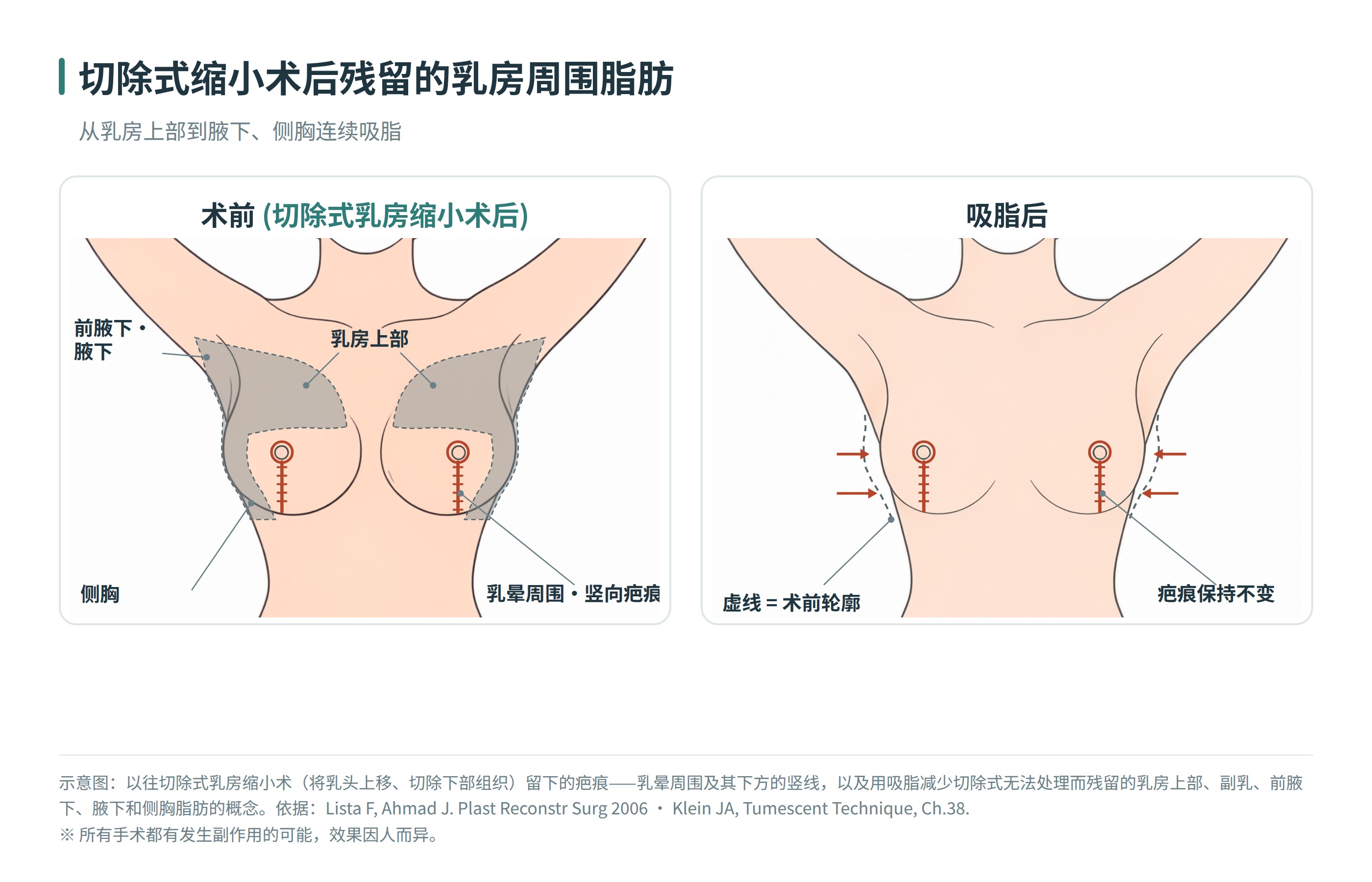 显示切除式乳房缩小术的竖向疤痕，以及吸脂缩小的乳房上部、副乳、前腋下、侧胸范围的示意图