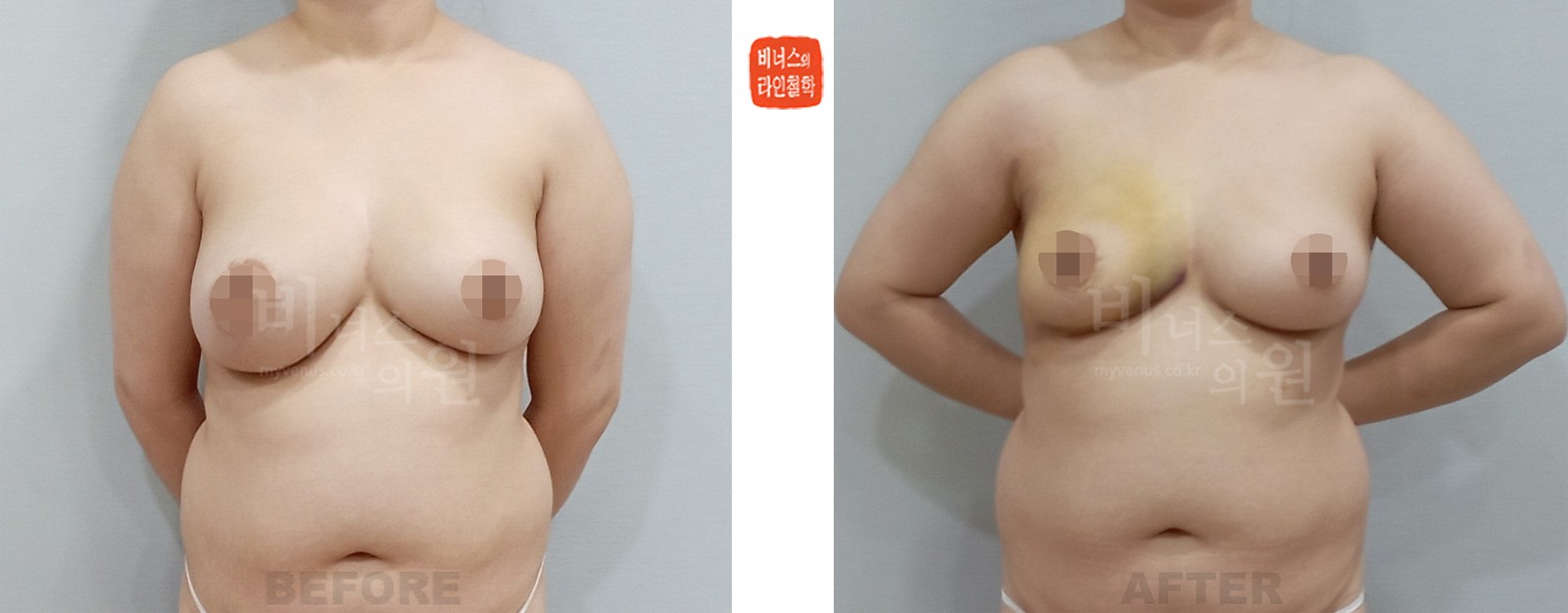 乳房不对称矫正吸脂前后对比照片 第一个案例（术后1周）