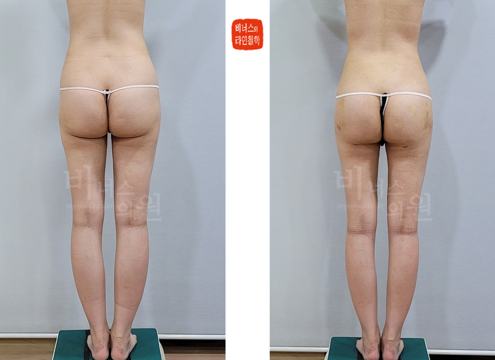 臀部、髋部、后腰吸脂前后对比照片 背面（术后1周）