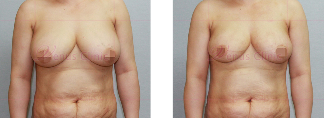 乳房缩小吸脂前后照片