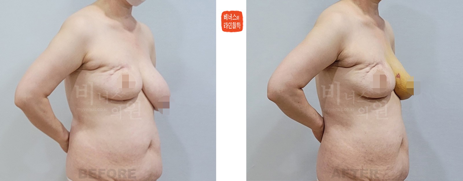乳腺癌术后乳房不对称缩胸吸脂前后对比照片 侧面（术后1周）