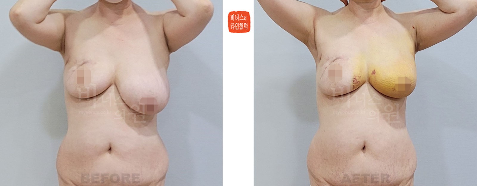 乳腺癌术后乳房不对称缩胸吸脂前后对比照片 正面（术后1周）
