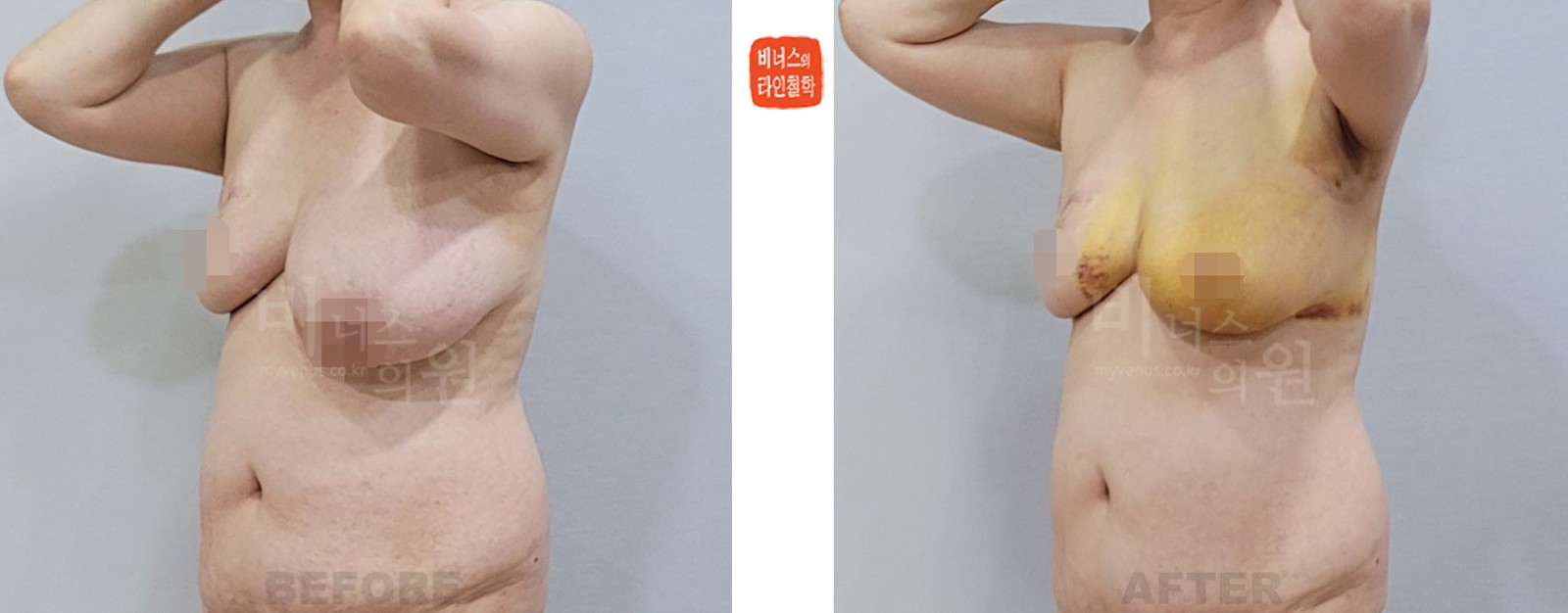乳腺癌术后乳房不对称缩胸吸脂前后对比照片 斜面（术后1周）