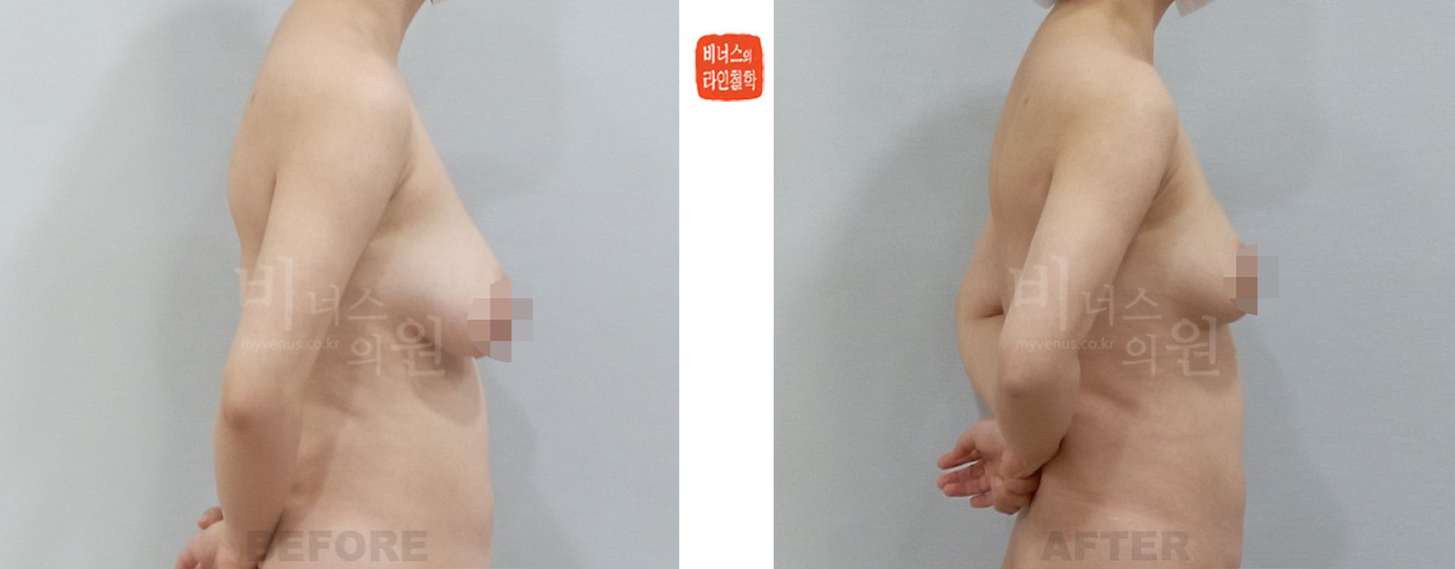 产后下垂乳房吸脂缩胸手术前后照片 侧面（术后1周）